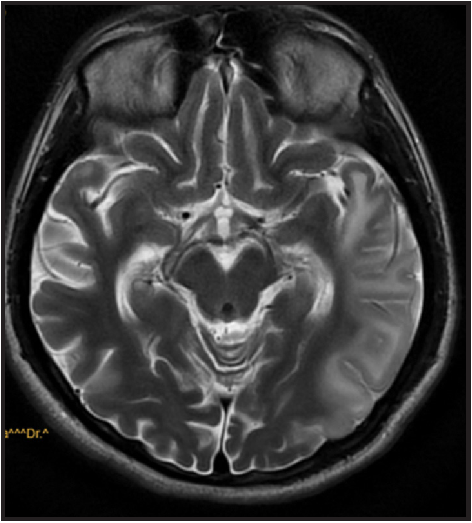 T2 hyperintensity over right temporal and left temporoparietal region.